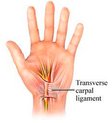 Carpal Tunnel Syndroom